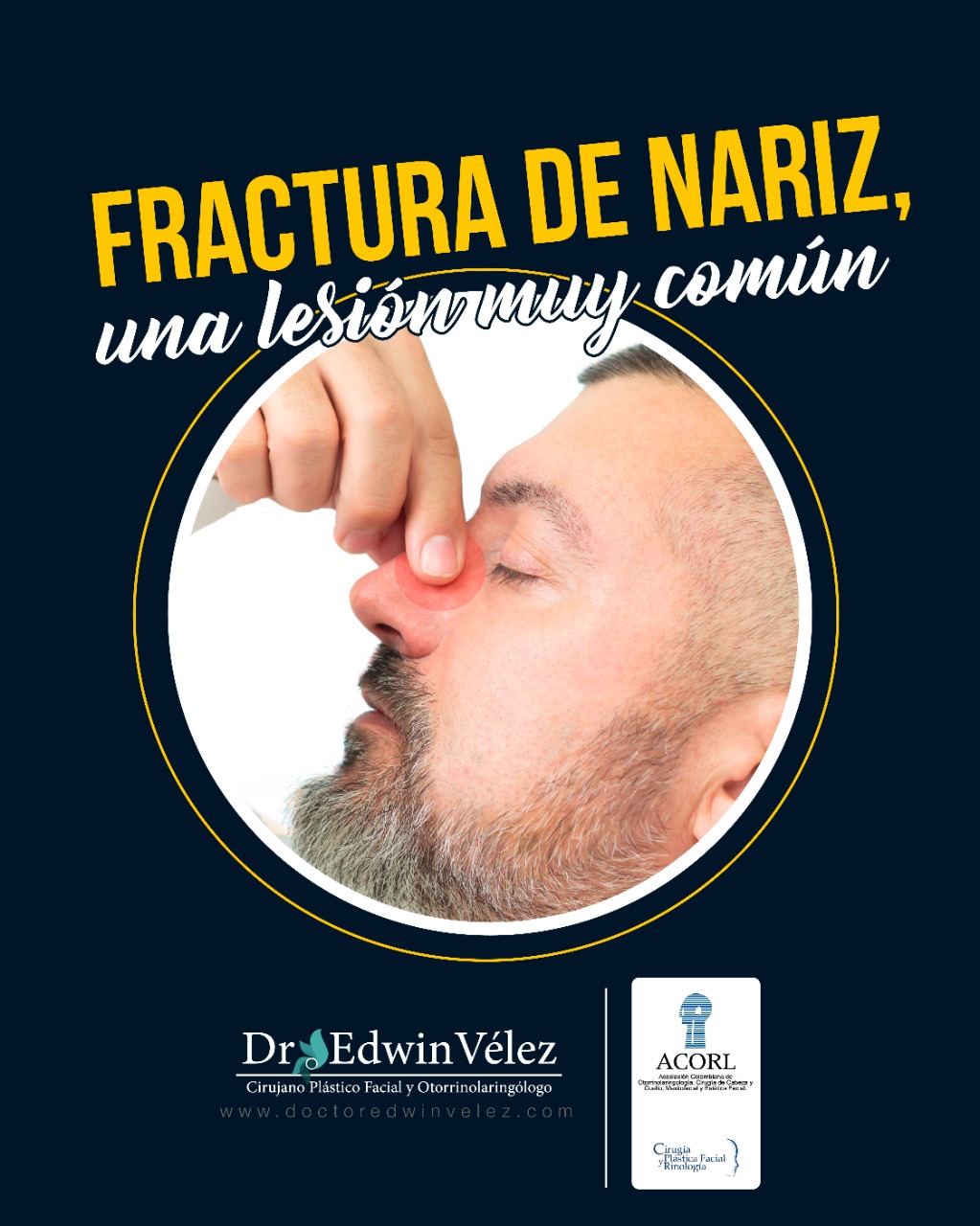 Todo lo que debemos saber sobre la Fractura de nariz - Doctor Edwin Vélez